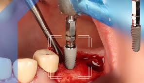 Implantology